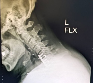 Name:  Neck X-Ray, L-Flex, Jun 2022 - cropped.jpg
Views: 545
Size:  30.2 KB